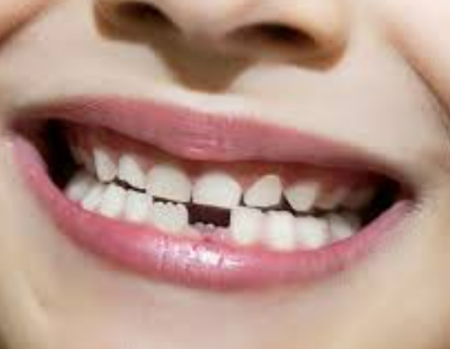 تفسير حلم سقوط الأسنان بدون دم للعزباء